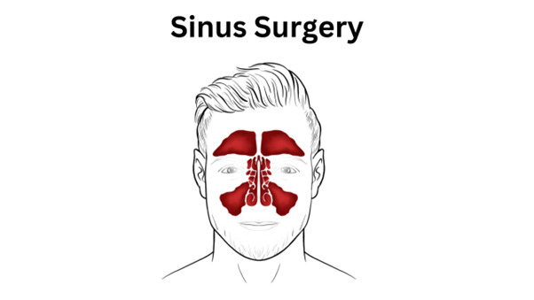 Sinus Surgery